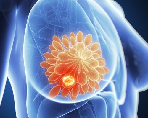 Improving-the-prediction-of-treat5x4ment-response-in-breast-cancer